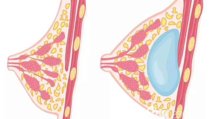 胸假體大小如何選擇