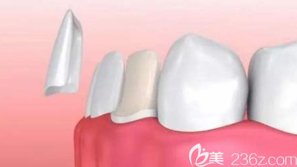 咼永洪醫(yī)生科普:牙貼面和美容冠哪個好 咼永洪醫(yī)生科普:牙貼面和美容冠哪個好