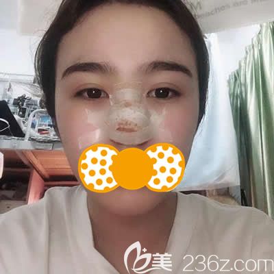 泉州歐菲劉俊醫(yī)生為我做鼻頭鼻翼縮小術后三天照片