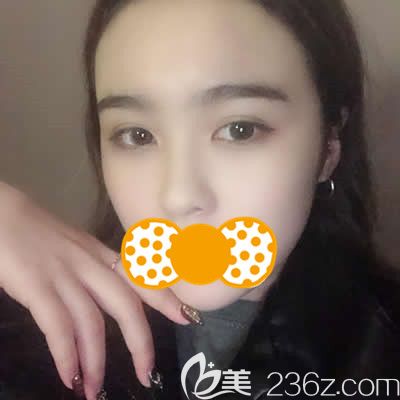 泉州歐菲劉俊醫(yī)生為我做鼻頭鼻翼縮小術后25天效果