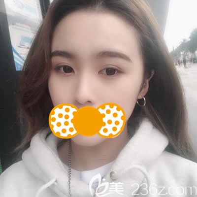 快看！我難看的大蒜鼻在泉州歐菲做了耳軟骨綜合隆鼻后回頭率暴漲