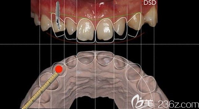 李小霞優(yōu)勢項目DSD微笑設(shè)計