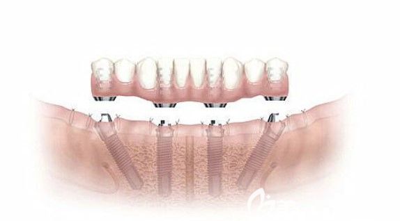 劉靖醫(yī)生特色種植牙項目ALL-ON-4 劉靖醫(yī)生特色種植牙項目ALL-ON-4