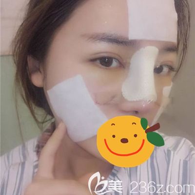 洛陽(yáng)毛大夫鼻綜合術(shù)后1天