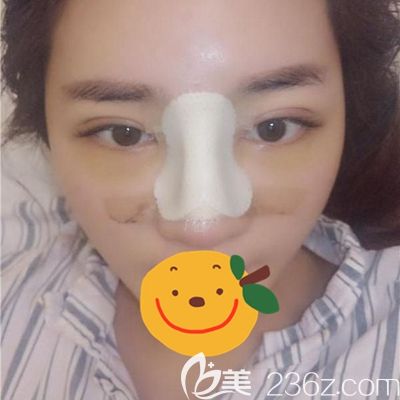 毛大夫鼻綜合術(shù)后3天