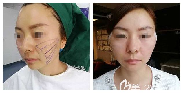 面診劃線后剛做<span style=