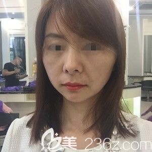 術(shù)后3天面部埋線還有些腫脹