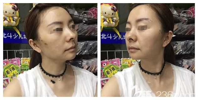 一周后埋線提升位置針眼還在恢復(fù)