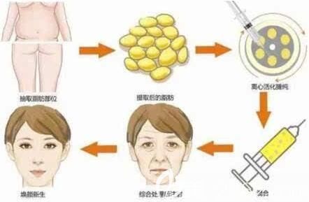 體脂肪移植填充面部過程示意圖