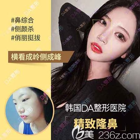 韓國DA整形外科鼻部整形優(yōu)惠 韓國DA整形外科鼻部整形優(yōu)惠
