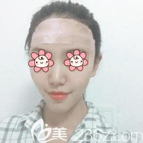 自體脂肪填充額頭術(shù)后第2天