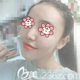 做自體脂肪填充額頭術(shù)后9天恢復(fù)<span style=