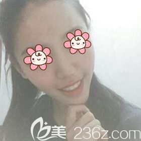 在湘潭雅美做自體脂肪填充額頭術(shù)后15天<span style=