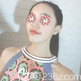 做完自體脂肪填充面部術(shù)后30天<span style=