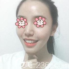 把我在湘潭雅美做自體脂肪豐額頭太陽穴術后45天恢復效果圖跟大家分享一下！