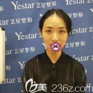 寧波藝星做雙眼皮前 寧波藝星做雙眼皮前