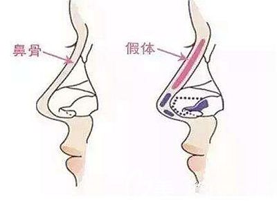 隆鼻假體植入的層次