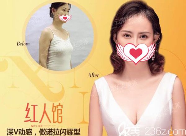 夏興國做假體隆胸效果對(duì)比圖 夏興國做假體隆胸效果對(duì)比圖