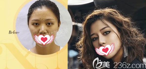 美萊整形楊繼紅做鼻綜合效果對(duì)比圖 美萊整形楊繼紅做鼻綜合效果對(duì)比圖
