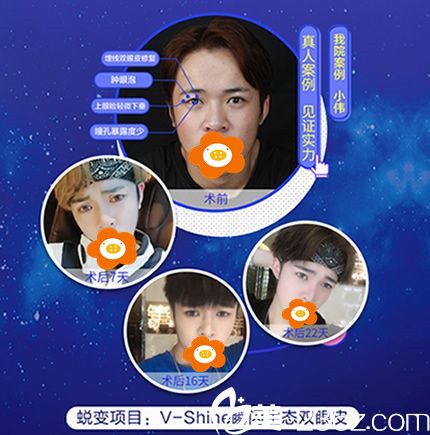 林曉雄V—Shine瞬閃雙眼皮真人案例效果