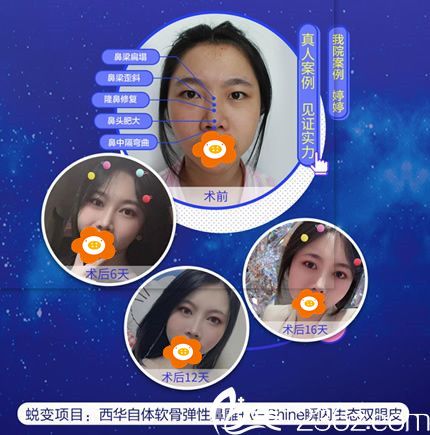 林曉雄自體軟骨隆鼻+V—Shine瞬閃雙眼皮前后照片