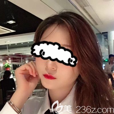 我都沒敢相信贛州葉子醫(yī)療美容鐘林輝給我做完自體脂肪填充全臉后變成了旺夫臉