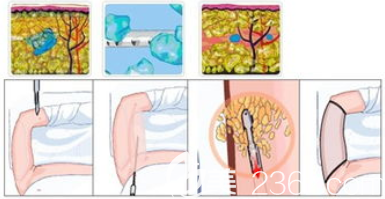 手臂吸脂手術(shù)過(guò)程圖