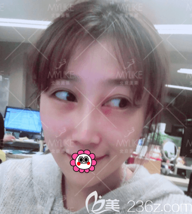 葉宇醫(yī)生給我做眶隔脂肪釋放和祛眼袋第7天樣子 葉宇醫(yī)生給我做眶隔脂肪釋放和祛眼袋第7天樣子