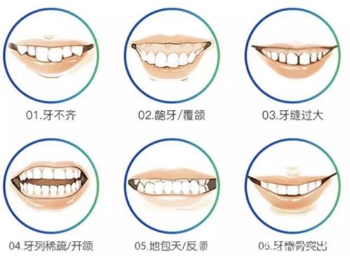 適合做牙齒矯正的類(lèi)型