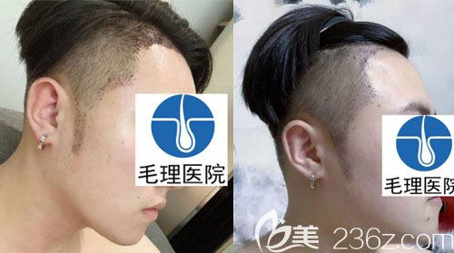 對(duì)比國內(nèi)與韓國植發(fā)價(jià)格后選韓國毛理醫(yī)院做鬢角植發(fā)+種植發(fā)際線圖片反饋