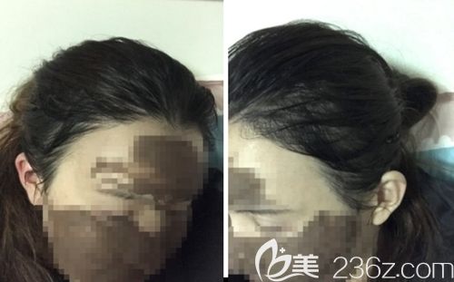 天生發(fā)際線稀少的我找韓國毛理醫(yī)院做了發(fā)際線移植后8個(gè)月的恢復(fù)情況