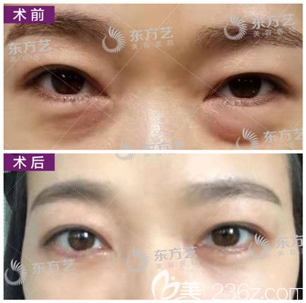 信陽東方藝整形祛眼袋真人案例