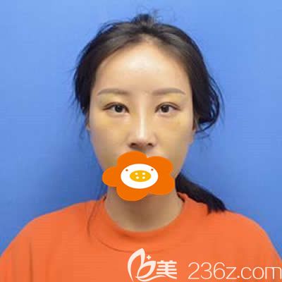福州美貝爾楊國化為我做肋軟骨隆鼻術(shù)后一周照片 福州美貝爾楊國化為我做肋軟骨隆鼻術(shù)后一周照片