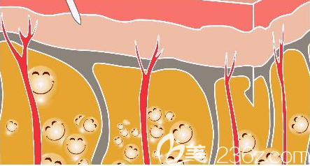 腹部吸脂手術(shù)示意圖