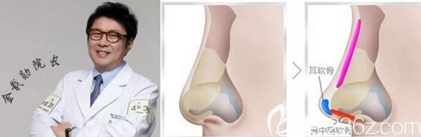 韓國4月31日整形外科金載勛隆鼻手術(shù)特色 韓國4月31日整形外科金載勛隆鼻手術(shù)特色