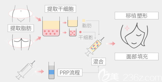 整形醫(yī)院面部脂肪填充原理圖 整形醫(yī)院面部脂肪填充原理圖