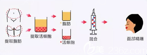 自體脂肪填充面部手術(shù)過程圖
