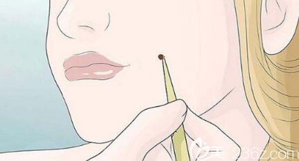 曲靖靖美祛痣的好方法