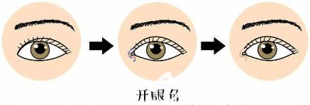 什么人需要開內眼角