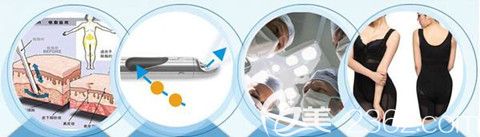 華億整形水動(dòng)力吸脂原理