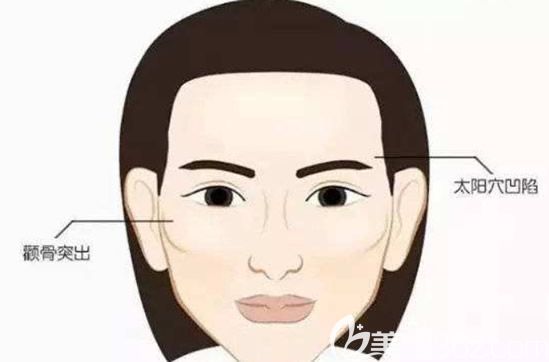 高顴骨的女人一般都有太陽穴凹陷的癥狀 高顴骨的女人一般都有太陽穴凹陷的癥狀