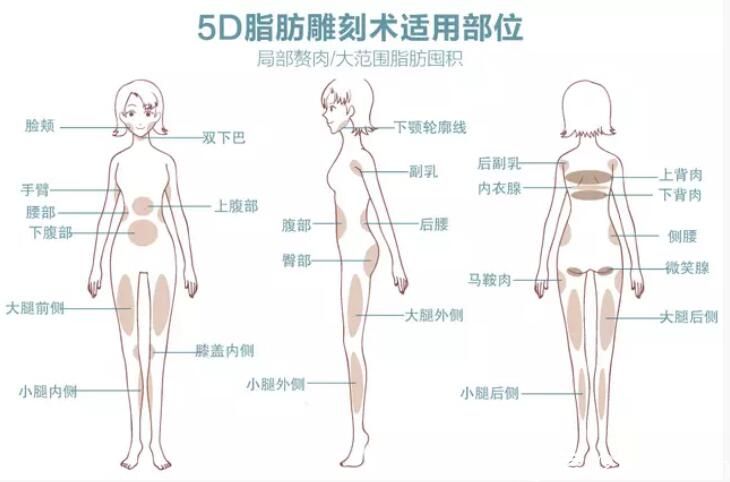 5D脂肪雕刻術(shù)部位示意圖