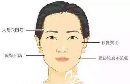 自體脂肪填充額頭