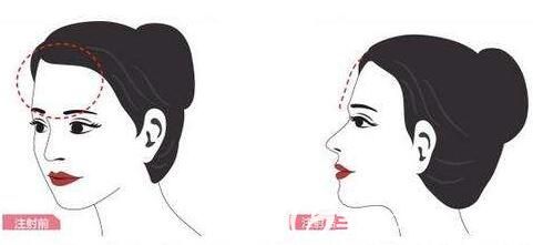 自體脂肪填充額頭原理