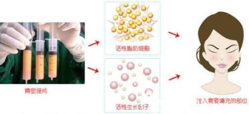 自體脂肪填充額頭后為什么有些人會像壽星一樣呢？