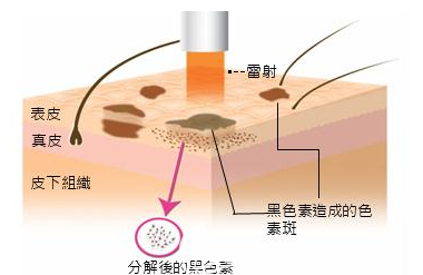 激光分解黑色素的過(guò)程