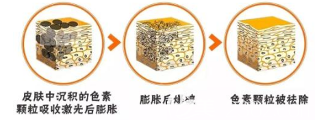 皮膚中的黑色素沉淀的過(guò)程