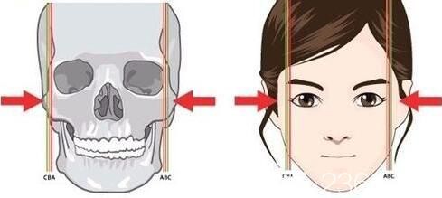 磨骨瘦臉后遺癥的危害
