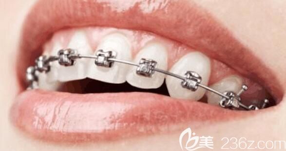 北京維嘉口腔張智慧醫(yī)生介紹美國(guó)3M直絲弓牙齒矯正優(yōu)勢(shì) 北京維嘉口腔張智慧醫(yī)生介紹美國(guó)3M直絲弓牙齒矯正優(yōu)勢(shì)