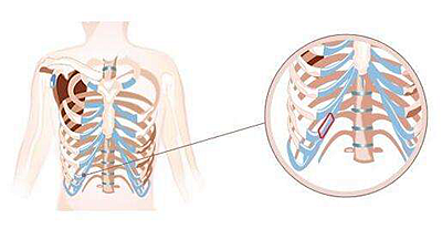 肋軟骨隆鼻的手術(shù)原理